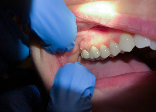Best Chipped Tooth Repair Near Me  in Water Mill, NY